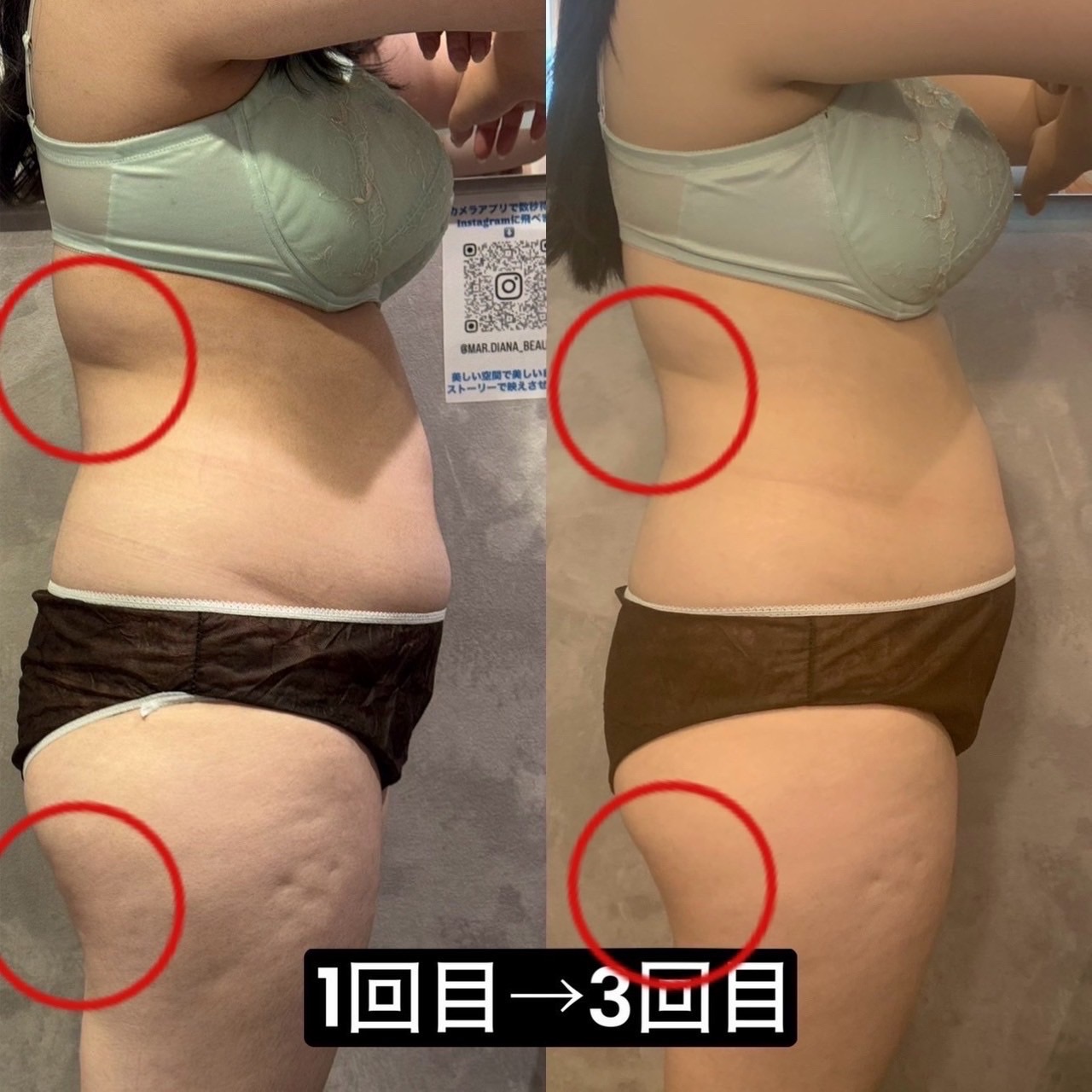 脂肪冷却痩身 1回目から3回目 腰まわり・太ももの変化