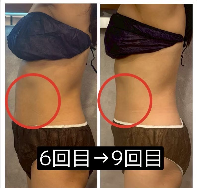 脂肪冷却痩身 6回目から9回目 お腹まわりの変化
