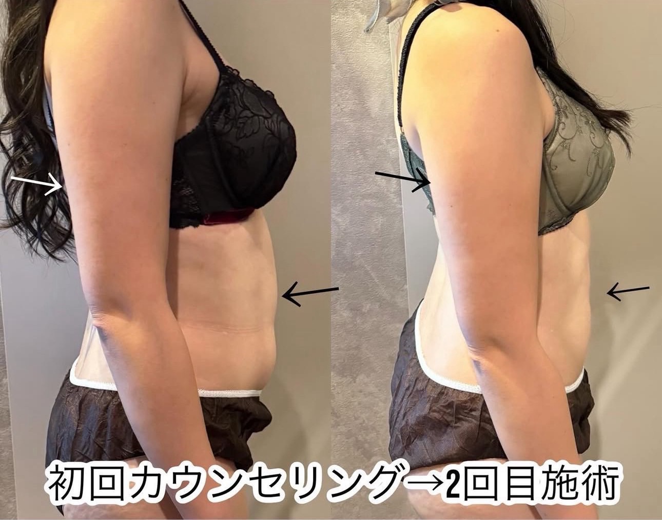 脂肪冷却痩身 初回カウンセリングから2回目施術 二の腕・お腹の変化