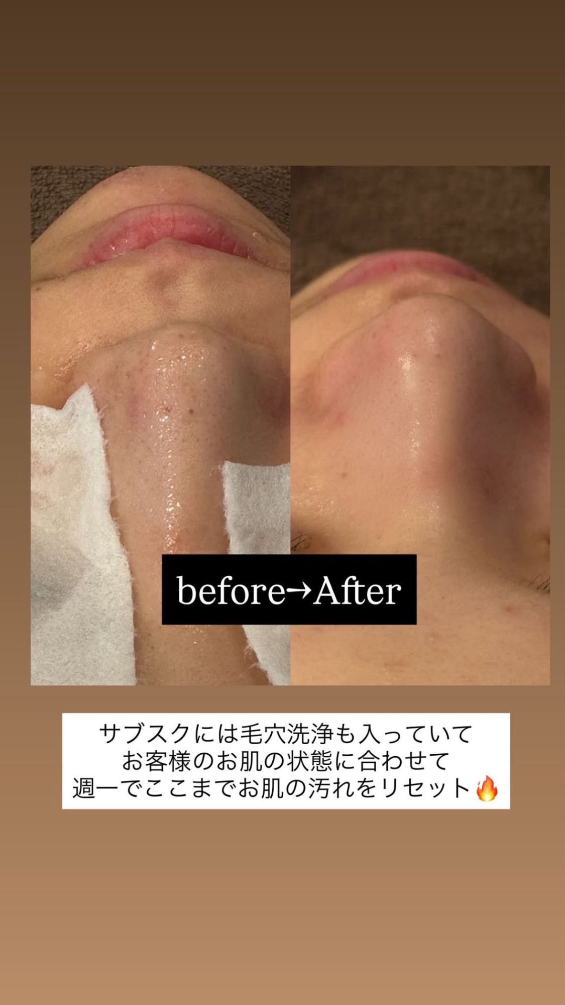 エクソソーム毛穴洗浄のビフォーアフター（小鼻・鼻先の毛穴）